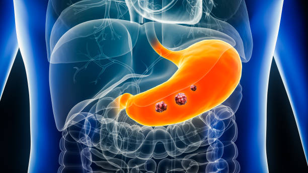 Stomach or gastric cancer with organs and tumors or cancerous cells 3D rendering illustration. Anatomy, oncology, biomedical, disease, medical, biology, science, healthcare concepts. Stomach or gastric cancer with organs and tumors or cancerous cells 3D rendering illustration. Anatomy, oncology, biomedical, disease, medical, biology, science, healthcare concepts. stomach cancer stock pictures, royalty-free photos & images