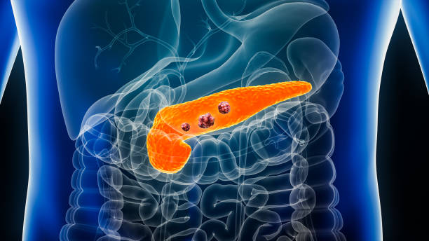Pancreas or pancreatic cancer with organs and tumors or cancerous cells 3D rendering illustration with male body. Anatomy, oncology, disease, medical, biology, science, healthcare concepts. stock photo