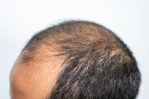 istock Side view of baldness man scalp. 1468066657