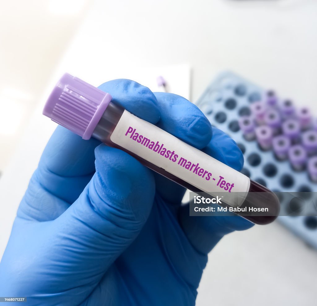 Blood Sample For Plasmablasts Marker Test As Biomarkers Of Diagnosis Blood Sample For Plasmablasts Marker Test As Biomarkers Of Diagnosis