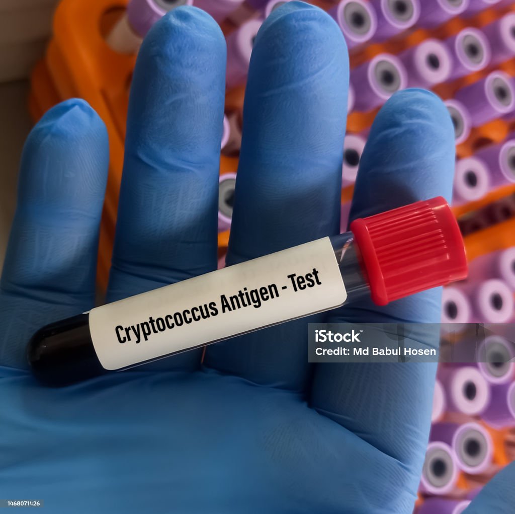 Blood Sample For Cryptococcus Antigen Test To Diagnosis Of Cryptococcal Blood Sample For Cryptococcus Antigen Test To Diagnosis Of Cryptococcal