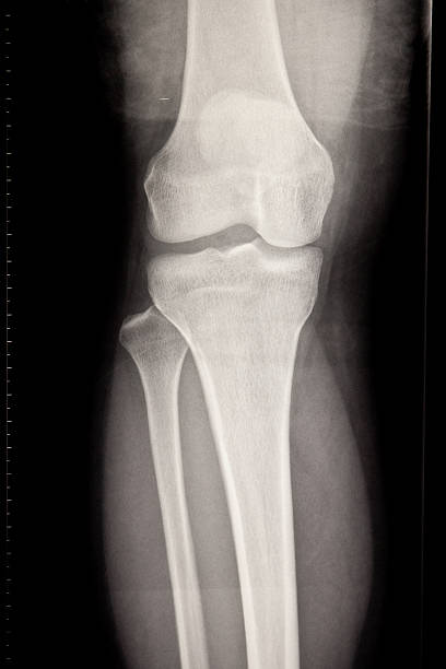genou x-ray - x ray human knee orthopedic equipment human bone photos et images de collection