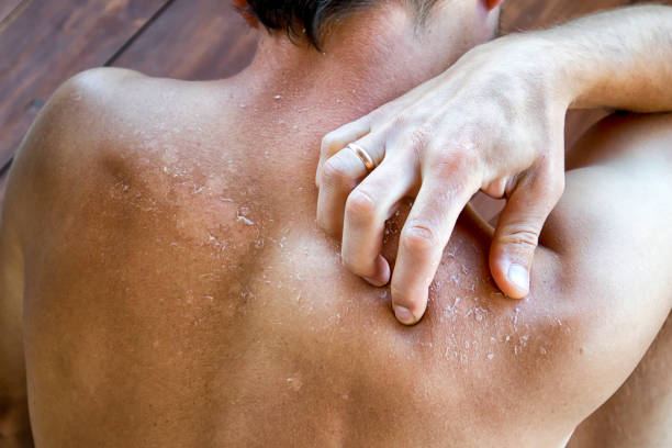 istock The dry and itching man's skin after sunbath 1468299999