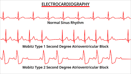 Subtle Mobitz Ii Set Of Ecg Common Abnormalities Normal Sinus Rhythm Mobitz Type 1 And 2 ...