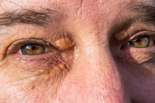 men's eyes with fat accumulations, Xanthelasmas men's eyes with fat accumulations, Xanthelasmas in Málaga, Andalusia, Spain eye test equipment stock pictures, royalty-free photos & images