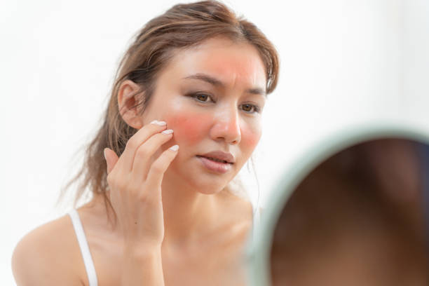 Young woman are worried about faces Dermatology and allergic to steroids in cosmetics. sensitive skin, red face from sunburn, acne, allergic to chemicals, rash on face. skin problems and beauty las mujeres jóvenes están preocupadas por las caras dermatología y alérgicas a los esteroides en cosméticos. piel sensible, cara roja por quemaduras solares, acné, alergia a los productos químicos, erupción en la cara. problemas de la piel y bellez