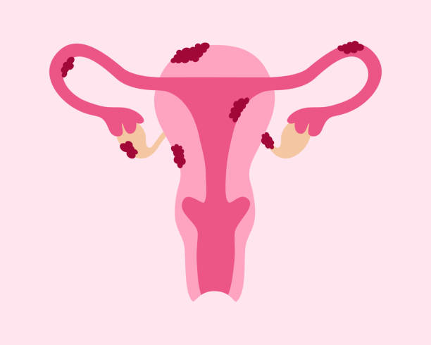 bildbanksillustrationer, clip art samt tecknat material och ikoner med endometriosis disease. uterus with tissue growth - äggledare illustrationer