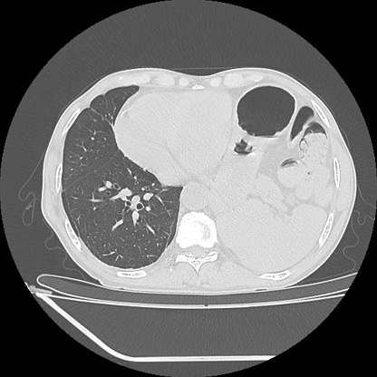axial lung window chest ct scan 50 years old patient with chest pain showing  bowel  dan gaster visible in  left chest and displacement of the mediastinum to the right
