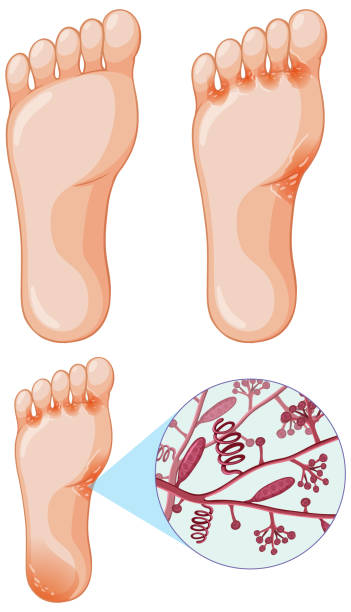 Trichophyton Rubrum fungal infection Trichophyton Rubrum fungal infection illustration Jock itch infection stock illustrations