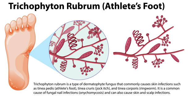 Trichophyton Rubrum fungal infection Trichophyton Rubrum fungal infection illustration trichophyton fungus stock illustrations