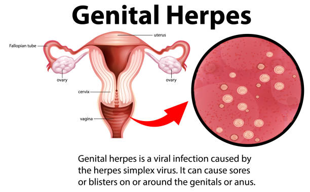 Genital Herpes infographic with explanation Genital Herpes infographic with explanation illustration genital herpes stock illustrations