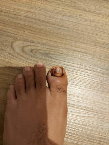 istock nail growth into the skin 1468725908