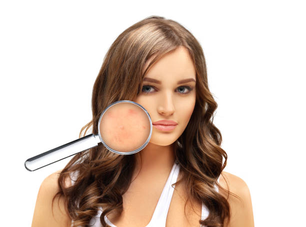 istock Post-Acne Marks /Treating Acne Scars.Acne Scar Removal 1468787201
