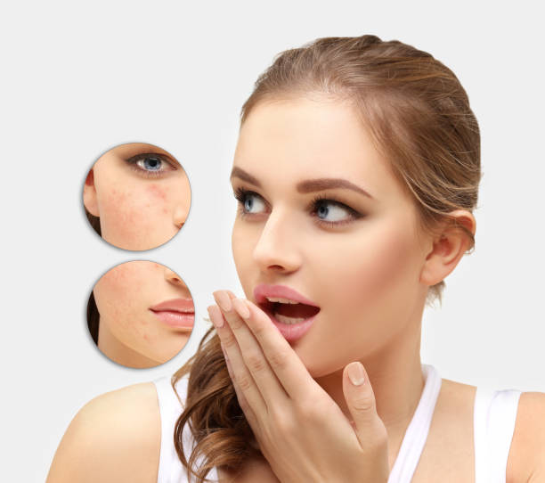 istock Post-Acne Marks .Treating Acne Scars.Acne Scar Removal 1468789395