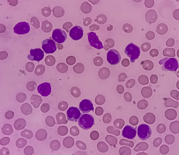 Lymphocytosis with Thrombocytopenia. Smear show white blood cells and red blood cells. Lymphocytosis with Thrombocytopenia. Smear show white blood cells, red blood cells background. Lymphoproliferative disorder. epstein barr virus photos stock pictures, royalty-free photos & images