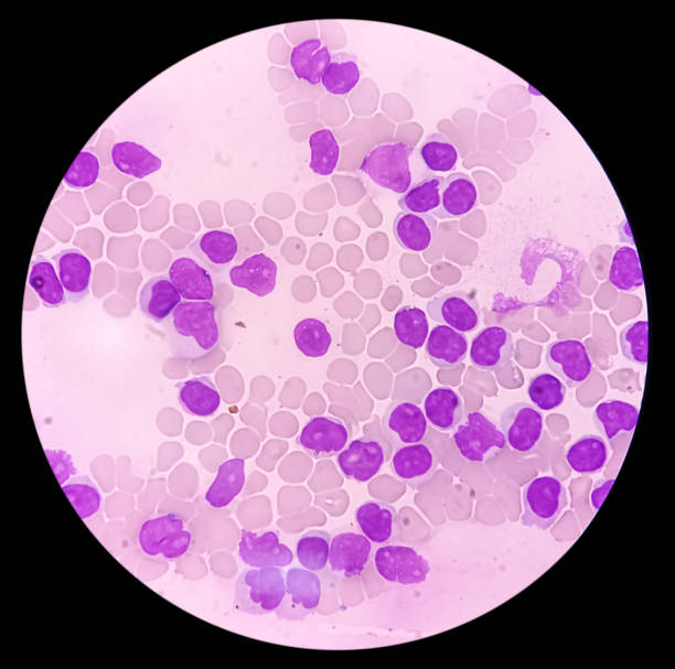 Lymphocytosis with Thrombocytopenia. Smear show white blood cells and red blood cells. Lymphocytosis with Thrombocytopenia. Smear show white blood cells, red blood cells background. Lymphoproliferative disorder. epstein barr virus photos stock pictures, royalty-free photos & images