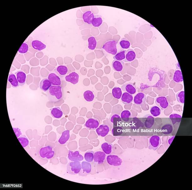 Lymphocytosis With Thrombocytopenia Smear Show White Blood Cells And Red Blood Cells Stock Photo - Download Image Now