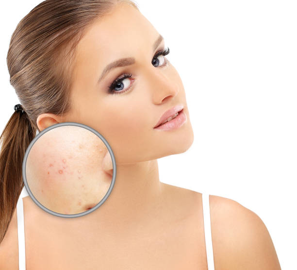 istock Post-Acne Marks .Treating Acne Scars.Acne Scar Removal 1468792762