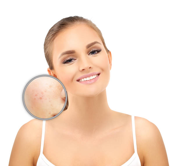 istock Post-Acne Marks Treating Acne Scars.Acne Scar Removal 1468793948