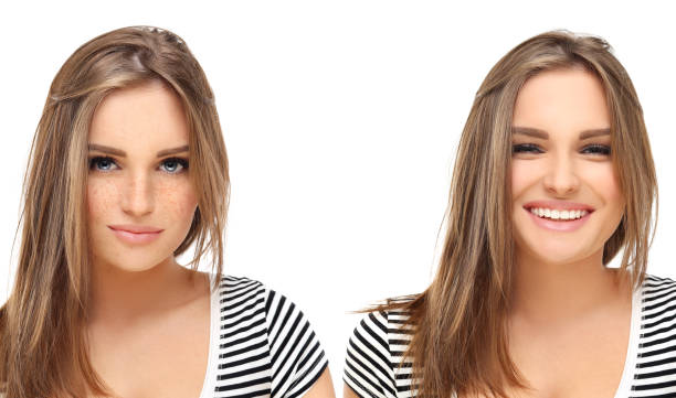 istock Freckles. Model's face divided in two parts 1468794165