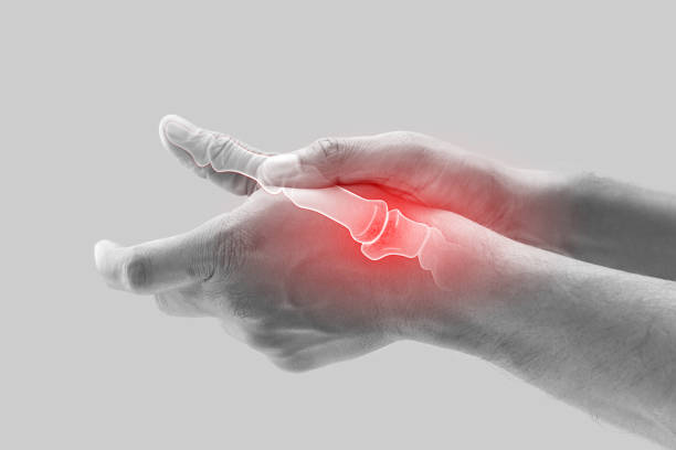 Arthritis of the finger and thumb joint. stock photo