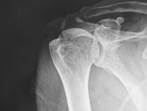 zdjęcie rentgenowskie , głowa kości ramiennej - arm bone audio zdjęcia i obrazy z banku zdjęć