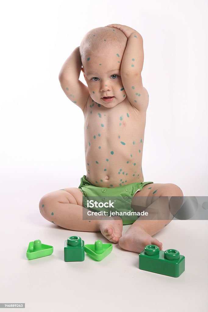 Niño jugando con la varicela y agarrando su jefe - Foto de stock de 18-23 meses libre de derechos