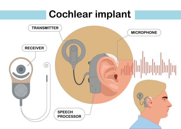 ilustraciones, imágenes clip art, dibujos animados e iconos de stock de dispositivo de implante coclear - listening people human ear speaker