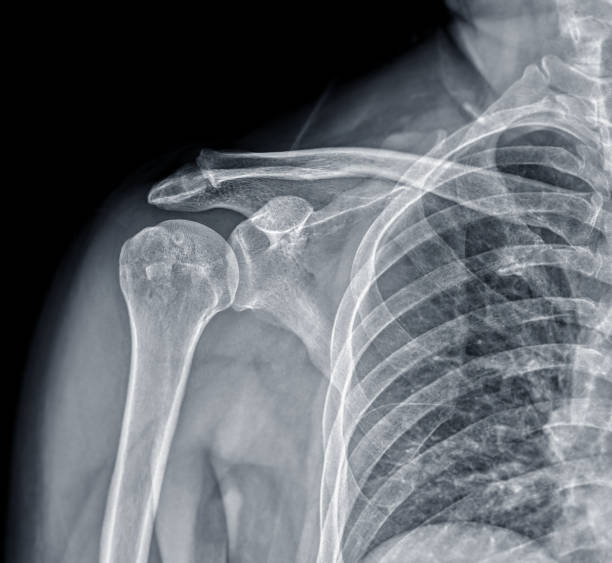 raio-x visão frontal do ombro da articulação do ombro para diagnóstico de fratura da articulação do ombro. - x ray x ray image shoulder human arm - fotografias e filmes do acervo