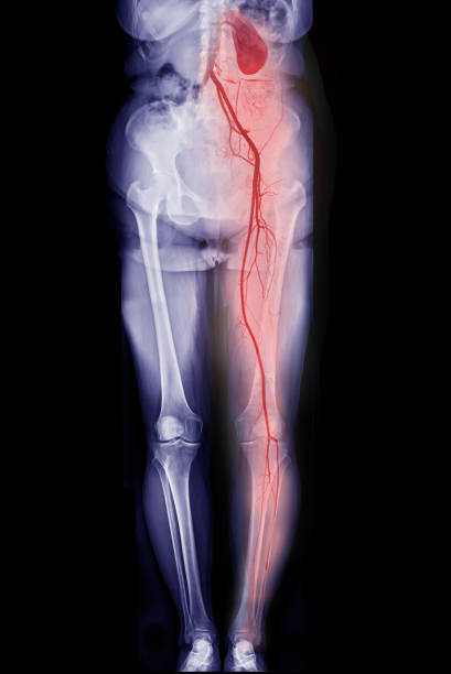 CTA femoral artery run off showing  femoral artery for diagnostic  Acute or Chronic Peripheral Arterial Disease. stock photo