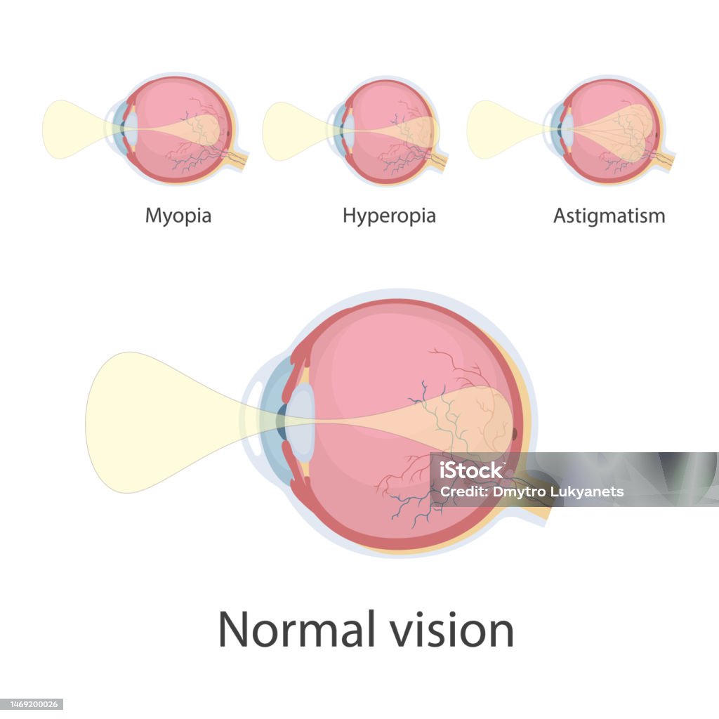 Hypermyopia Visual Defect Eye Defects Stock Illustration - Download Image Now - Astigmatism ...