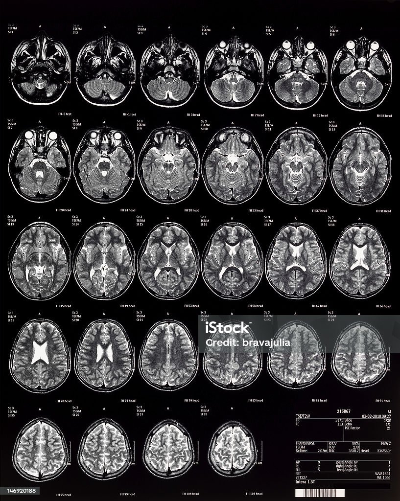 뇌 MRI 보그다 10 years - 로열티 프리 MRI 스캔 스톡 사진