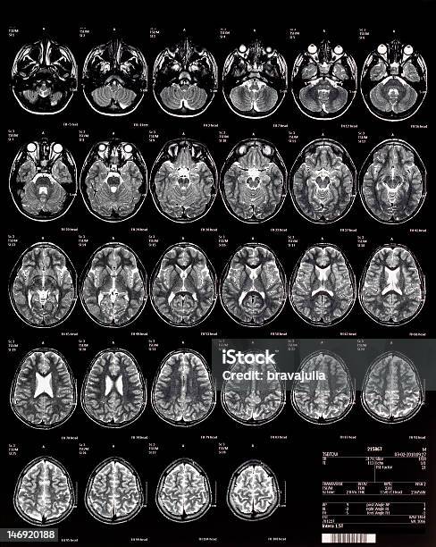 뇌 Mri 보그다 10 Years MRI 스캔에 대한 스톡 사진 및 기타 이미지 - MRI 스캔, 아이, 의료용 스캔