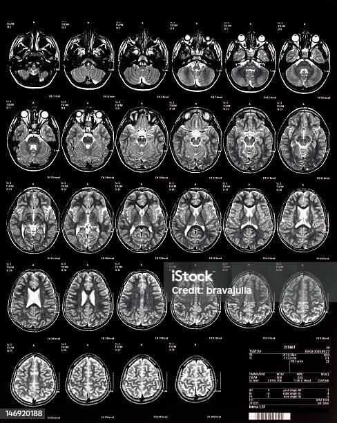 Cérebro De Rmn Crianças 10 Anos - Fotografias de stock e mais imagens de Exame de Ressonância Magnética - Exame de Ressonância Magnética, Criança, Exame Médico com Imagem de Diagnóstico