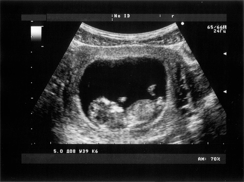 Obstetric Ultrasonography of third Month Fetus