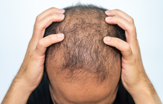 It usually follows a pattern of receding hairline and hair thinning on the crown.