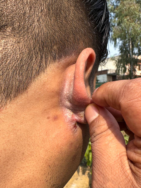 Stock photo showing an Indian man showing the sore, dry skin behind his earlobe. imagen en primer plano de la parte posterior de la cabeza de una persona irreconocible con peinado afeitado, hombre sosteniendo el lóbulo de la oreja para mostrar dolor de oreja, eccema infectado, piel seca, disparo en la cabeza, vista trasera