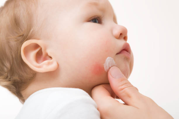 doigt de mère de jeune adulte appliquant une pommade médicale blanche sur la joue du nourrisson sur fond gris clair. éruption cutanée rouge sur la peau. allergie aux aliments, aux préparations lactées ou au lait maternel. prenez soin du corps de béb - human skin dry human face peeling photos et images de collection