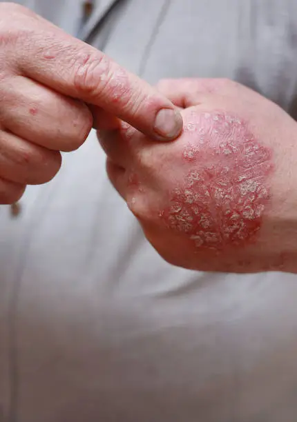 Photo of Close up of male showing hands with cracked, hard, horny, flaky skin. Dermatological problems of psoriasis, allergy, eczema. Hand stains, rash, dry skin. The concept of chronic disease treatment.