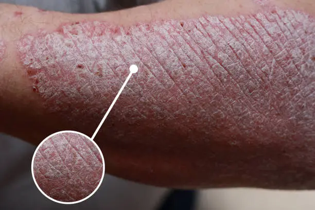 Photo of Macro detailed circles magnification of psoriasis skin, autoimmune disease that affects the skin cause skin inflammation red and scaly. Skin allergy with severe symptoms. Dermatitis rash and eczema.