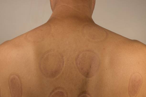 istock Mature man that had Cupping Therapy done on his back for pain relief 1469538294