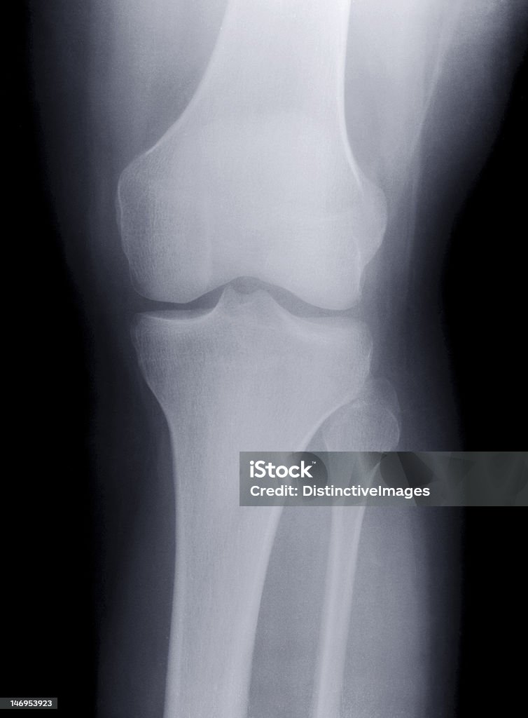 X-ray Knie - Lizenzfrei Anatomie Stock-Foto