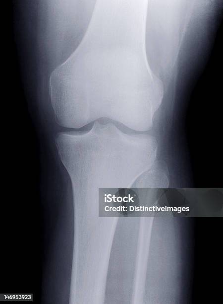 Xray Knie Stockfoto und mehr Bilder von Anatomie - Anatomie, Arthritis, Daten