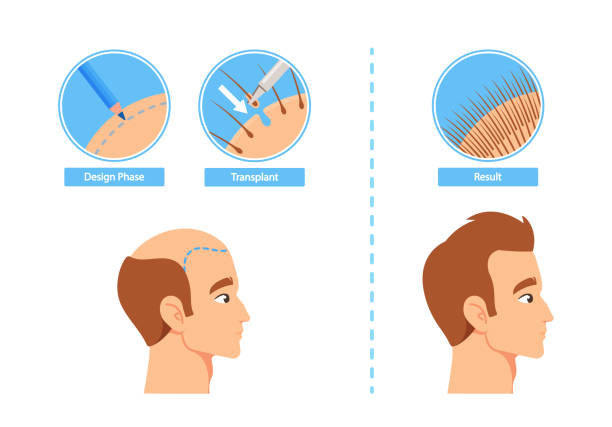 kuvapankkikuvitukset aiheesta hiustensiirtoprosessin infografiikat, mukaan lukien suunnitteluvaihe, elinsiirto ja tulosvaiheet. ennen ja jälkeen kuvia - receding hairline