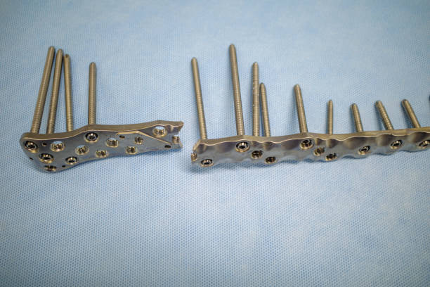 istock a broken titanium plate was explanted in one patient 1469675665