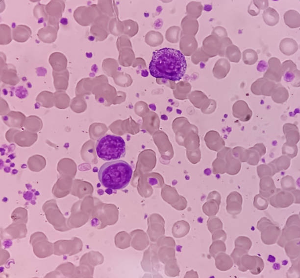 istock Chronic myeloid leukemia (CML) in accelerated phase also known as Chronic myelogenous leukemia. Thrombocytosis. Red blood cell. Blood smear. 1469720860