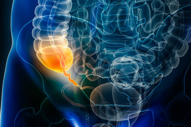 istock Appendicitis disease or vermiform appendix inflammation 3D rendering illustration. Anatomy, surgery, biomedical, disease, medical, biology, science, healthcare concepts. 1469805413