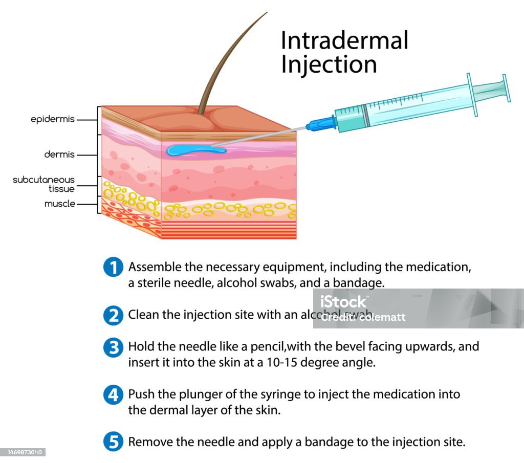 Intrascar Injection Intradermal Injection With Explanation Stock Illustration - Download ...