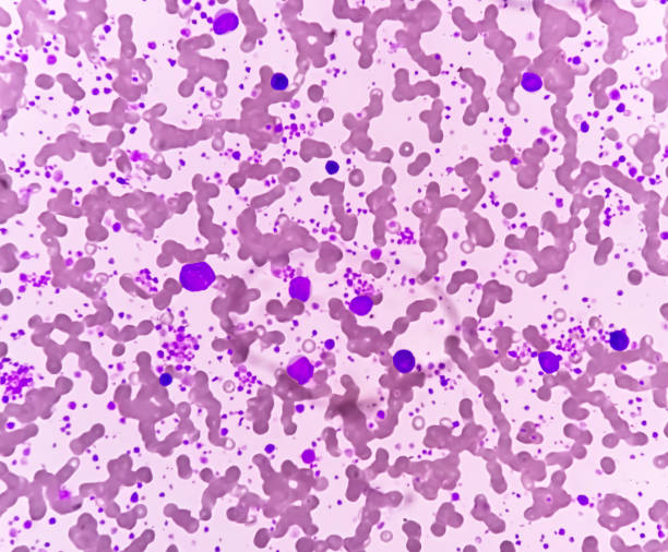istock Chronic myeloid leukemia (CML) in accelerated phase with thrombocytosis. Chronic myelogenous leukemia. 1469890192