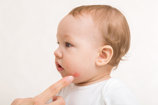 Young adult mother finger pointing to red rash on infant cheek. Baby boy isolated on light gray background. Allergy from food, milk formula or mother milk. Skin problem. Closeup. Side view.